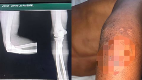 Violento asalto en Camagüey deja a joven con brazo fracturado