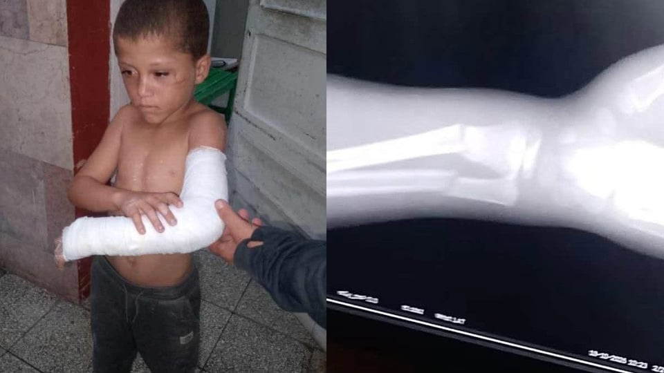 ¡Pobre niño en Matanzas! Cinco días con el brazo roto y sin yeso en el hospital
