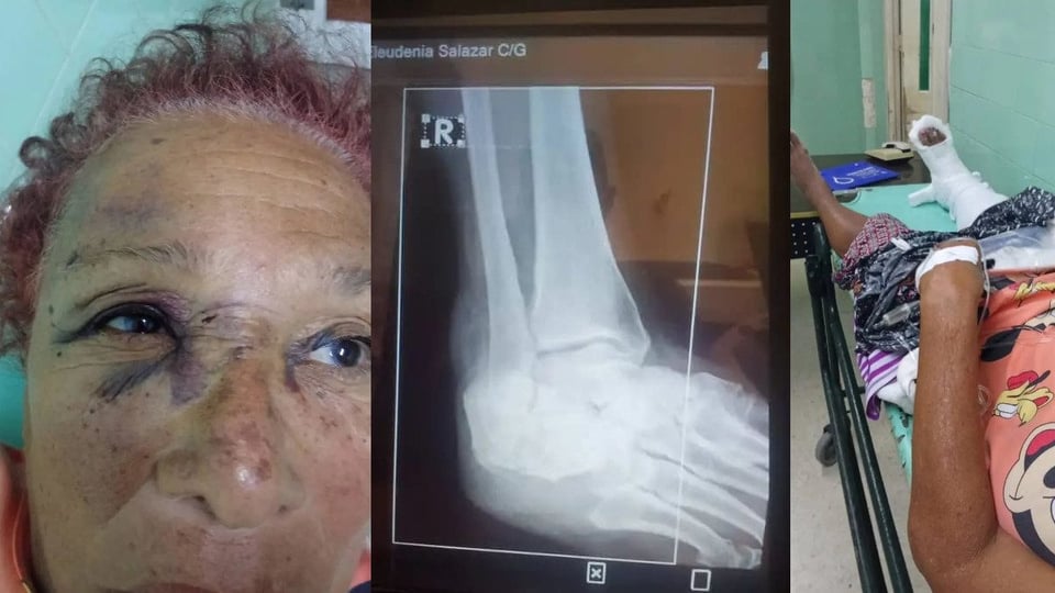 ¡Tremendo Bochinche! Paciente con Cuatro Fracturas Espera Cirugía en Santiago de Cuba