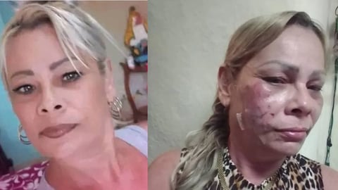 Cuban Dissident Marianela Peña Released After Arrest, Showing Facial Injuries