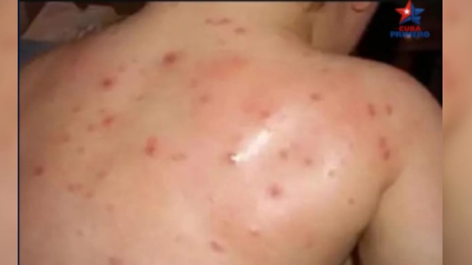 ¿Brote de Varicela en Prisión Cubana? Preso Político Estaría Sin Atención Médica