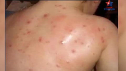 Brote de Varicela Denunciado en Prisión Cubana; Presos Afectados por Falta de Medicamentos