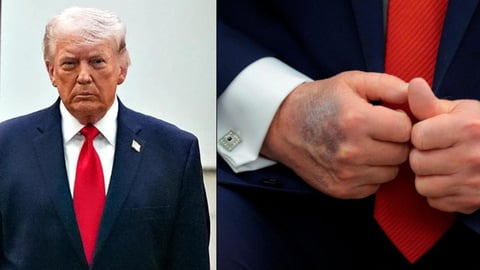 La Salud de Donald Trump en Foco: Peso, Hematomas y Debate Político