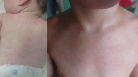 Madre Cubana Denuncia Apagones de 36 Horas y Afectaciones en la Piel de su Bebé