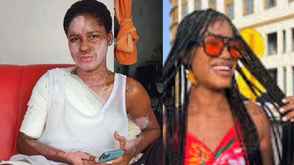 ¡Riri Riri en candela! Modelo relata su lucha tras sufrir quemaduras