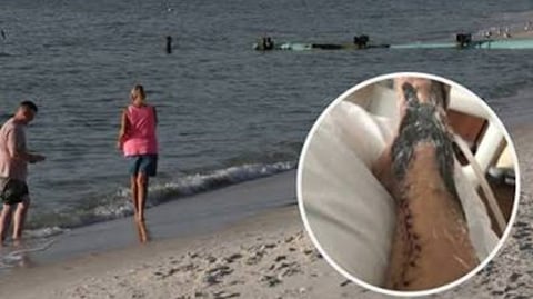 Bacteria 'Flesh-Eating' Claims Life in Florida Amidst Rising Cases