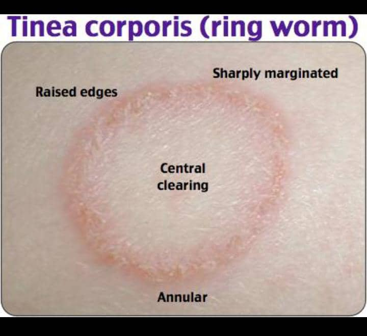 Tiña corporal
