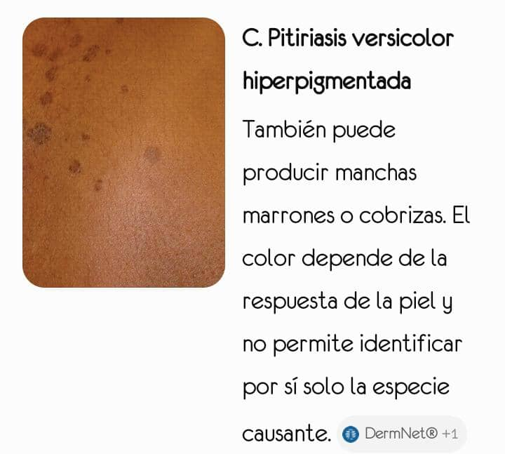Lesiones por Malassezia