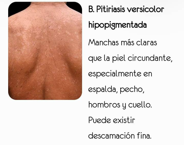 Pitiriasis versicolor