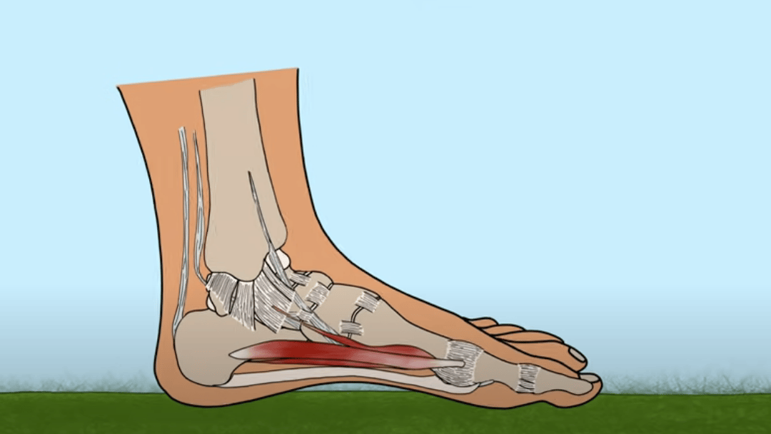 How to Fix Flat Feet (fallen arches) in 4 Steps