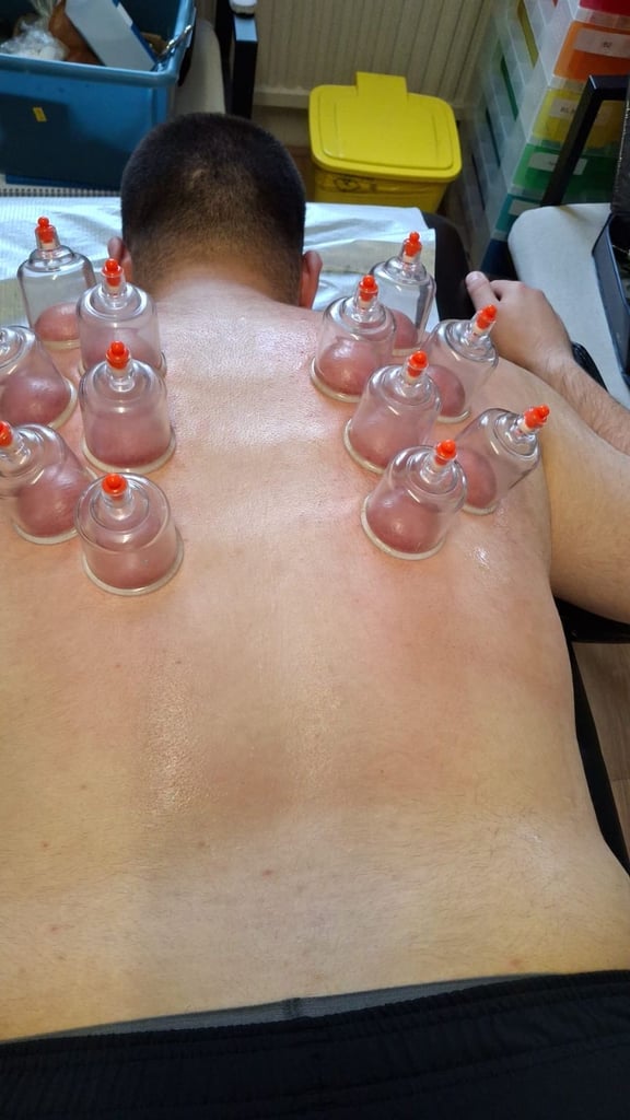 image for Start Your Journey with Hijama Cupping Therapy! ✨