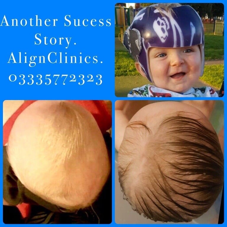 Plagiocephaly, Brachycephaly, Flat Head Syndrome Helmet Treatment for Babies with a Mis-shaped Head