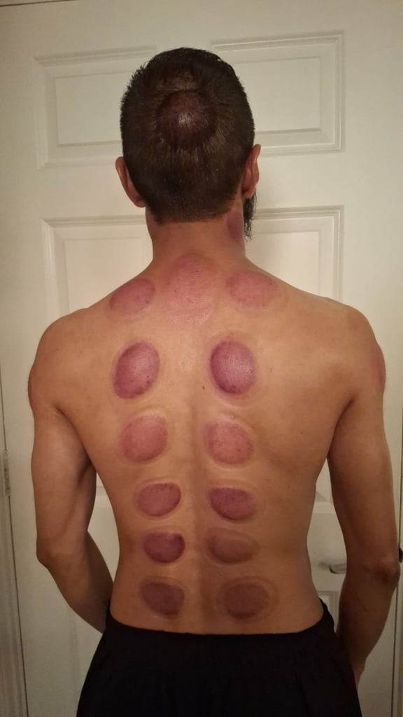 Become a Certified Hijama Therapist – Hijama Cupping Course UK