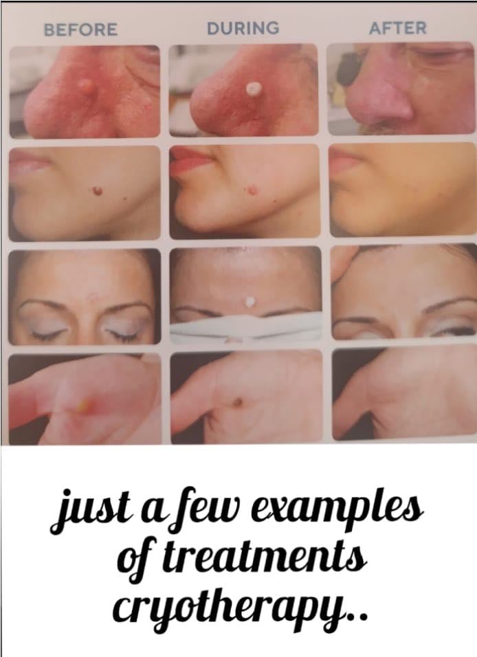 image for  Cryotherapy for  Removal of skin tags, age spots, dark sun spots,