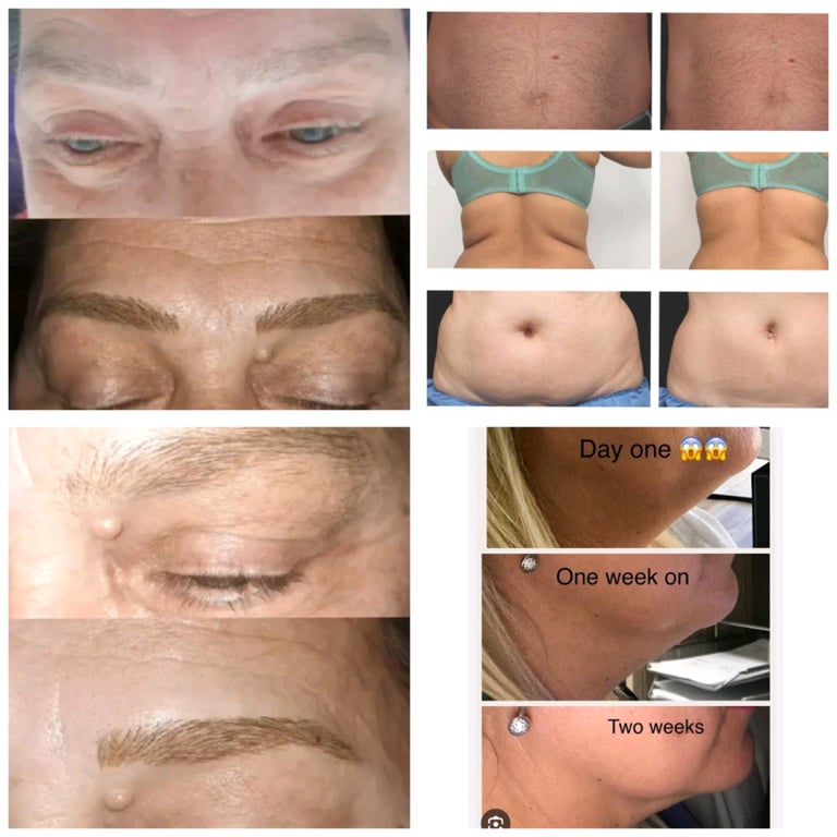 image for Eyebrow microblading & fat dissolving 
