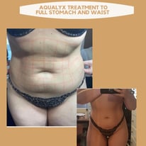 Aqualyx Fat Loss Injections enfield