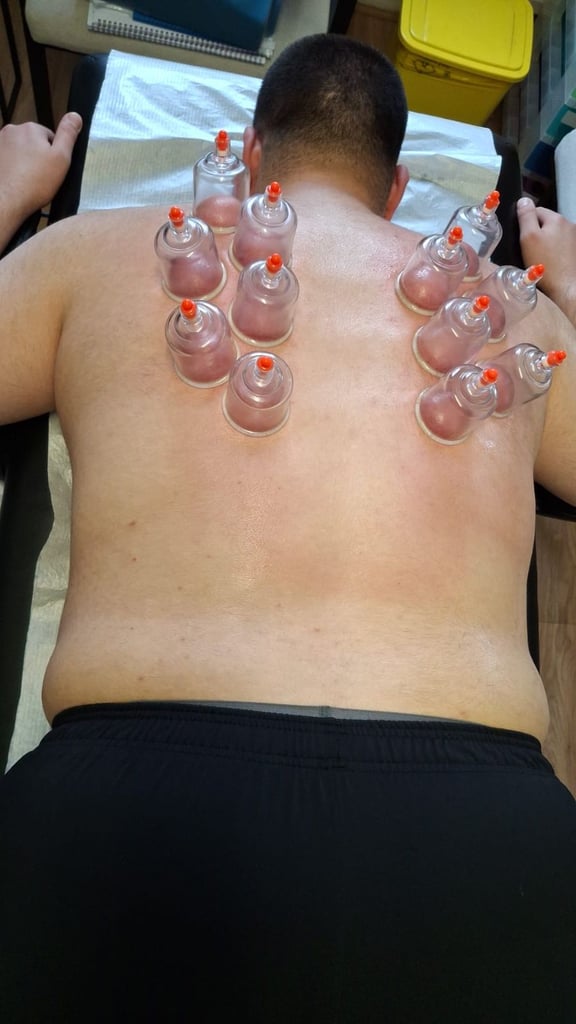 Start Your Journey with Hijama Cupping Therapy! ✨