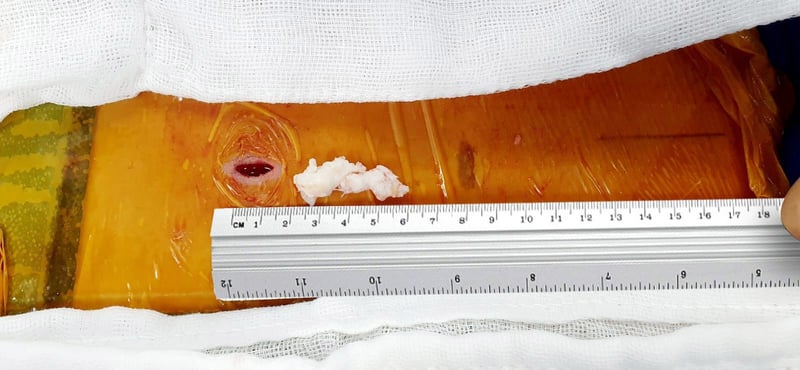 Endoscopic spine surgery incision about two centimetres long next to a ruler, with the removed disc fragment beside it