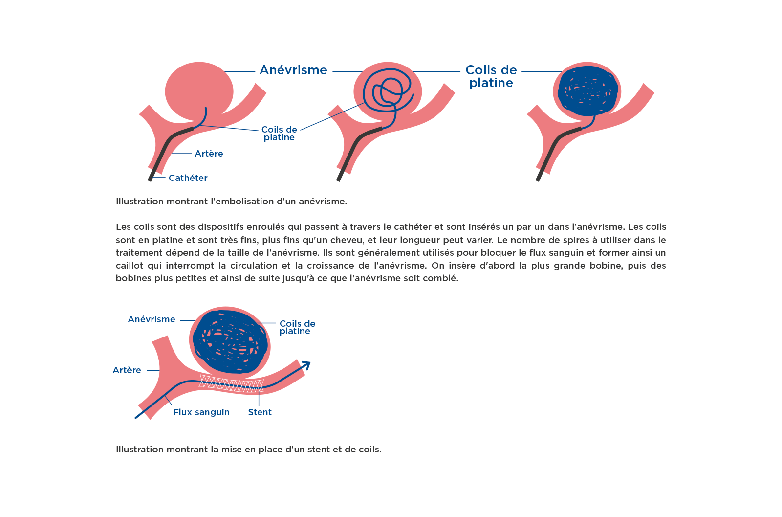 Illustration montrant l'embolisation d'un anévrisme.