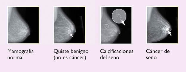 ¿Cómo se ve el cáncer de mama en una resonancia magnética?