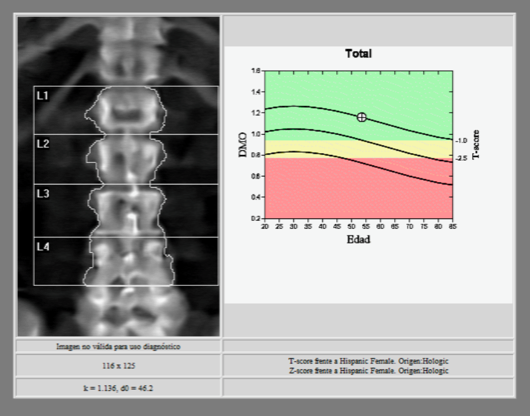 DEXA scan report of the lumbar spine (L1 to L4) with a bone mineral density chart by age; the reading falls in the normal green range