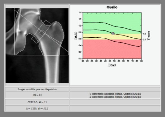 DEXA scan report of the femoral neck with a bone mineral density chart by age; the reading falls in the yellow, low bone mass range