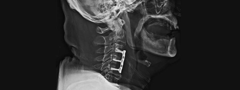 ecupera tu Movilidad: Descubre la Discectomia Cervical en Hospital CMQ Riviera Nayarit