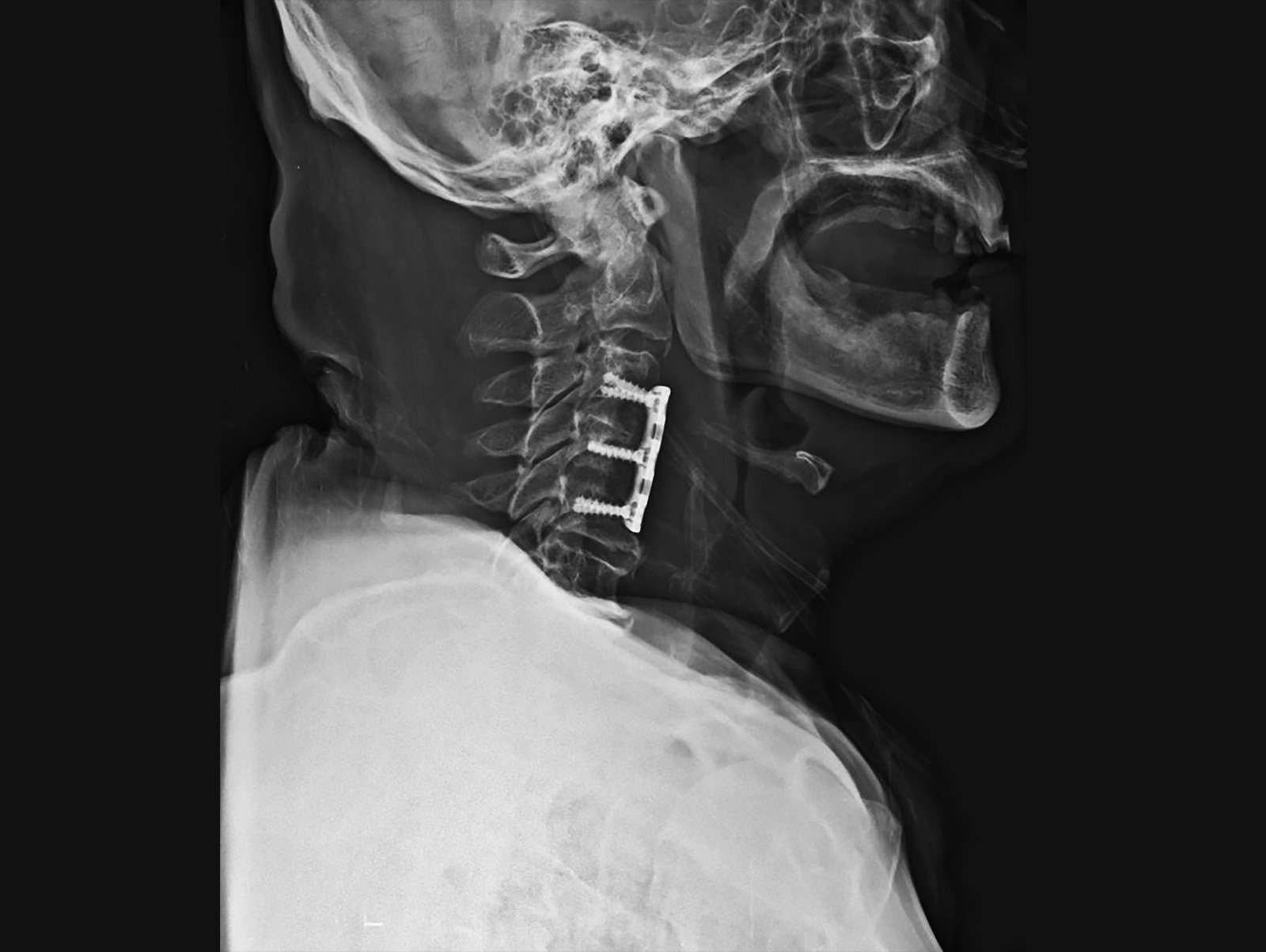 ecupera tu Movilidad: Descubre la Discectomia Cervical en Hospital CMQ Riviera Nayarit