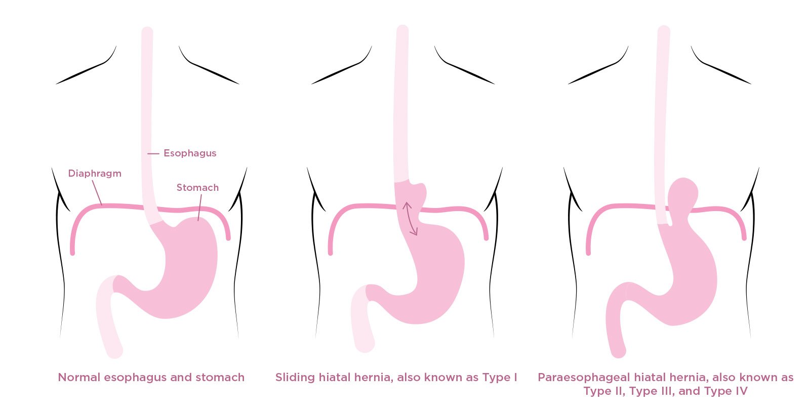 Types of Hiatal Hernia