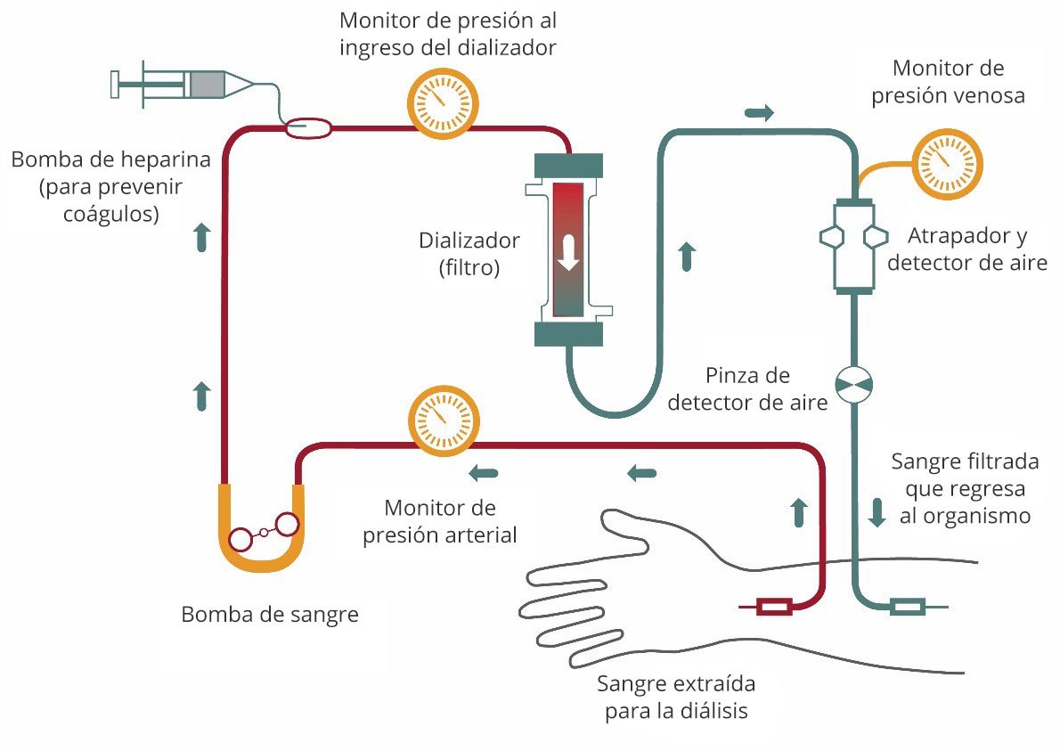 El Proceso de Hemodiálisis Paso a Paso