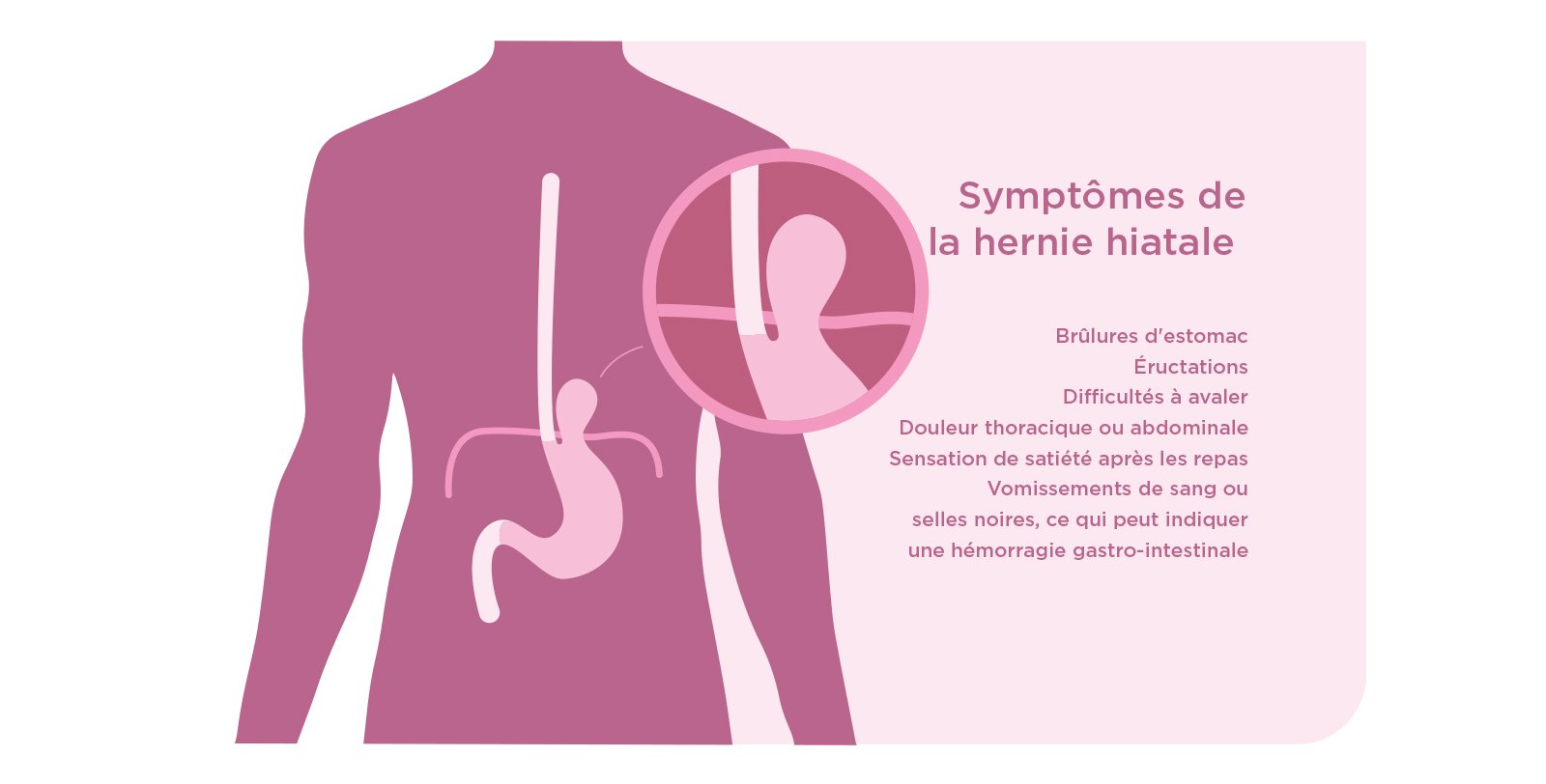 Symptômes de la hernie hiatal