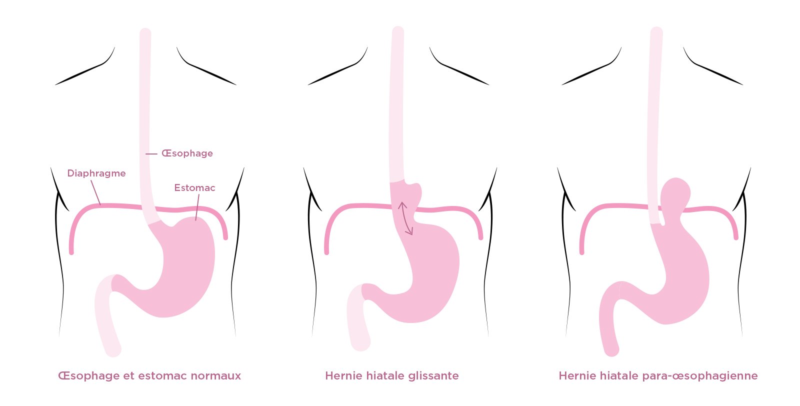 Types de hernie hiatale