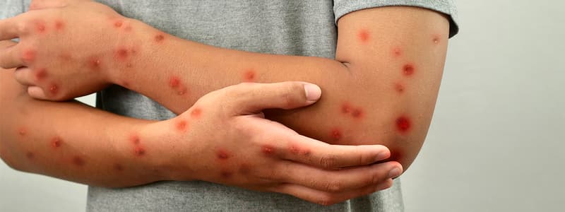 Alerta Global por la MPOX: Viruela Símica, conoce aquí todos los detalles