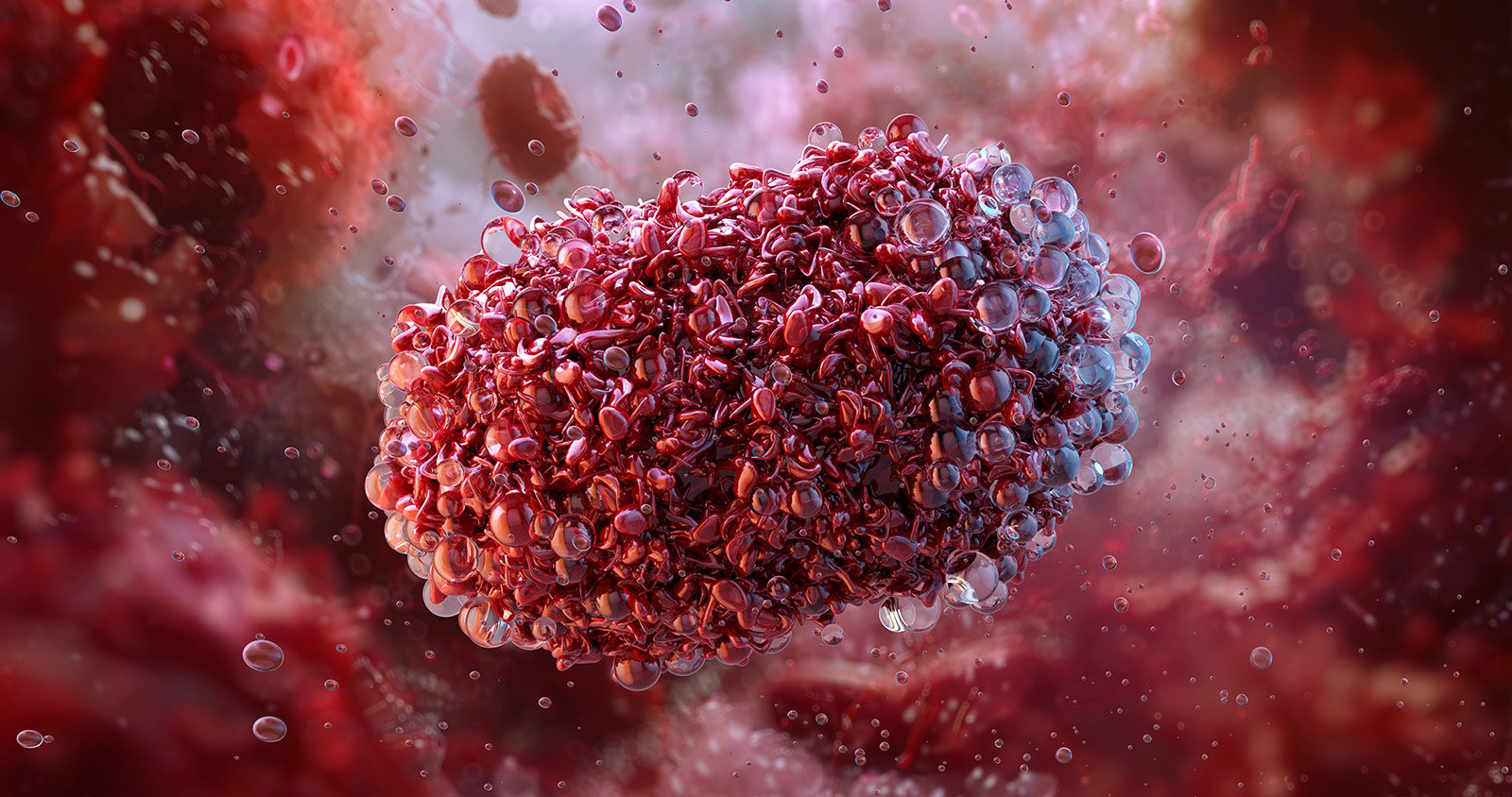 ¿Es MPOX la siguiente pandemia?