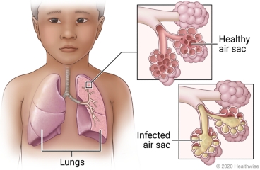 Signs of Pneumonia in Kids
