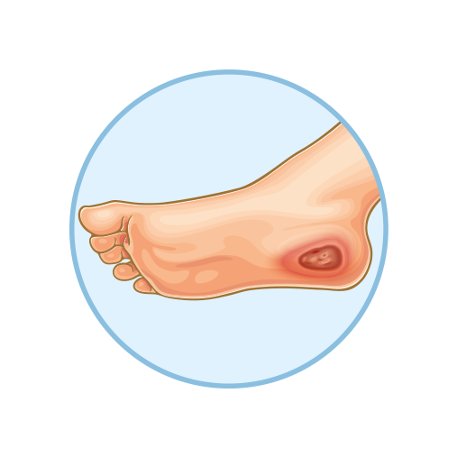 Pie diabetico - Grado 3 - Sin lesiones visibles