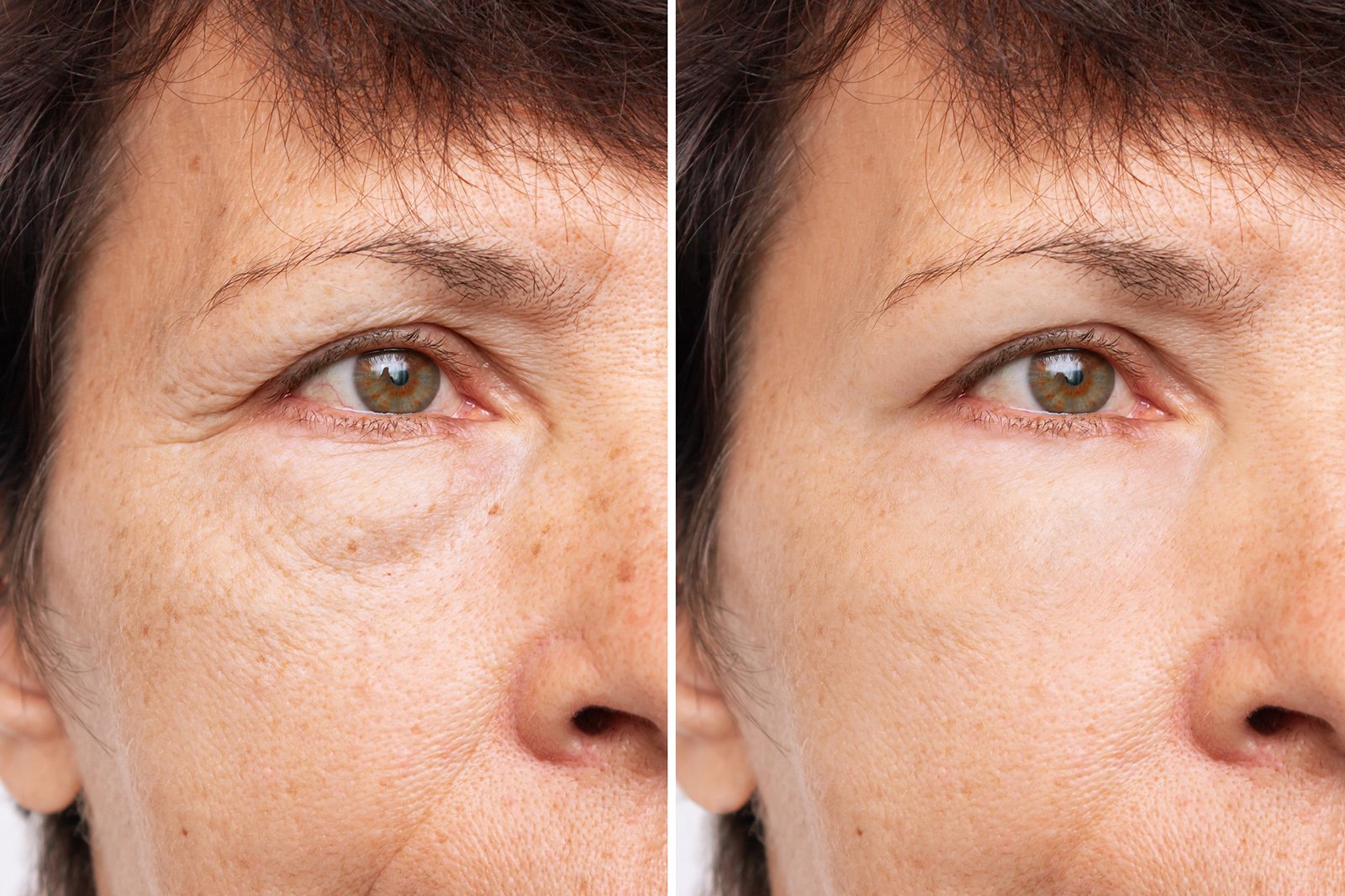 Antes y Después de una Blefaroplastia