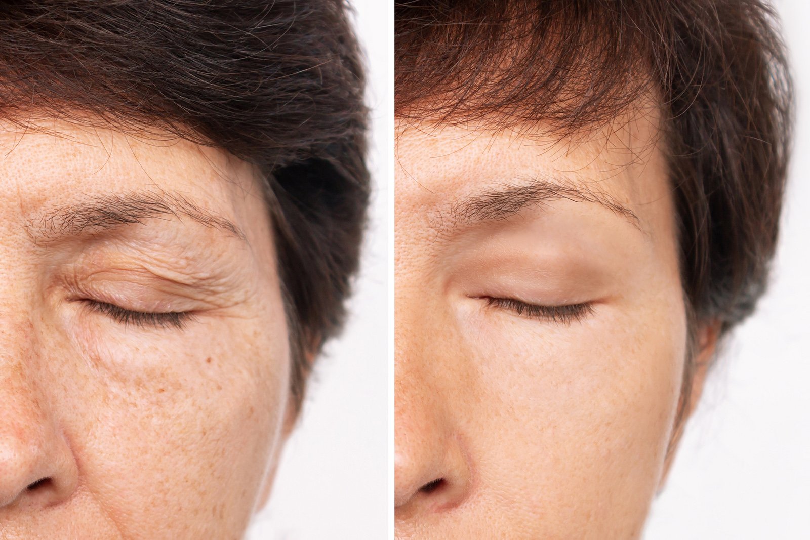 Antes y Después de una Blefaroplastia