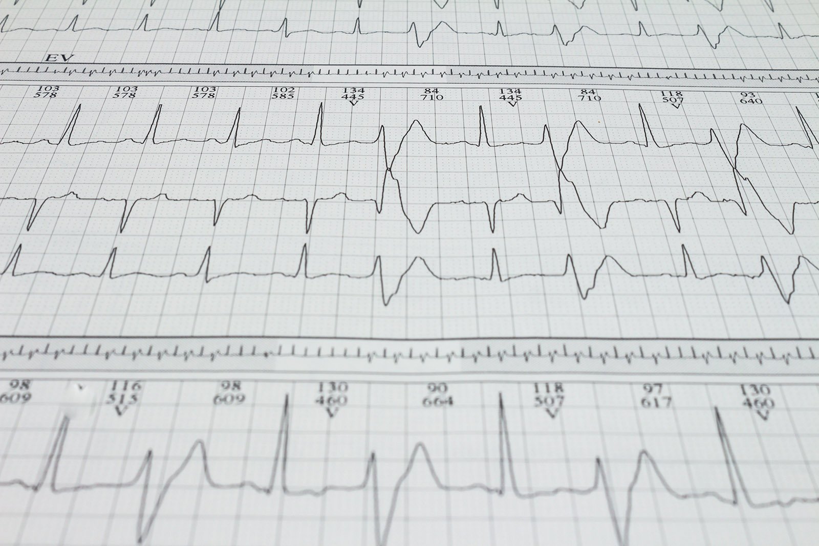 Imágenes de Resultados del Estudio Holter, ¿Qué significa mi resultado?