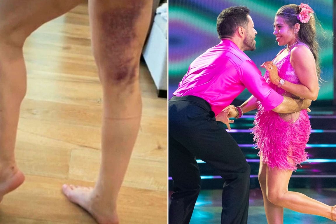 Do you think Danielle Fishel’s hamstring tear will affect her dance and scores throughout the season?