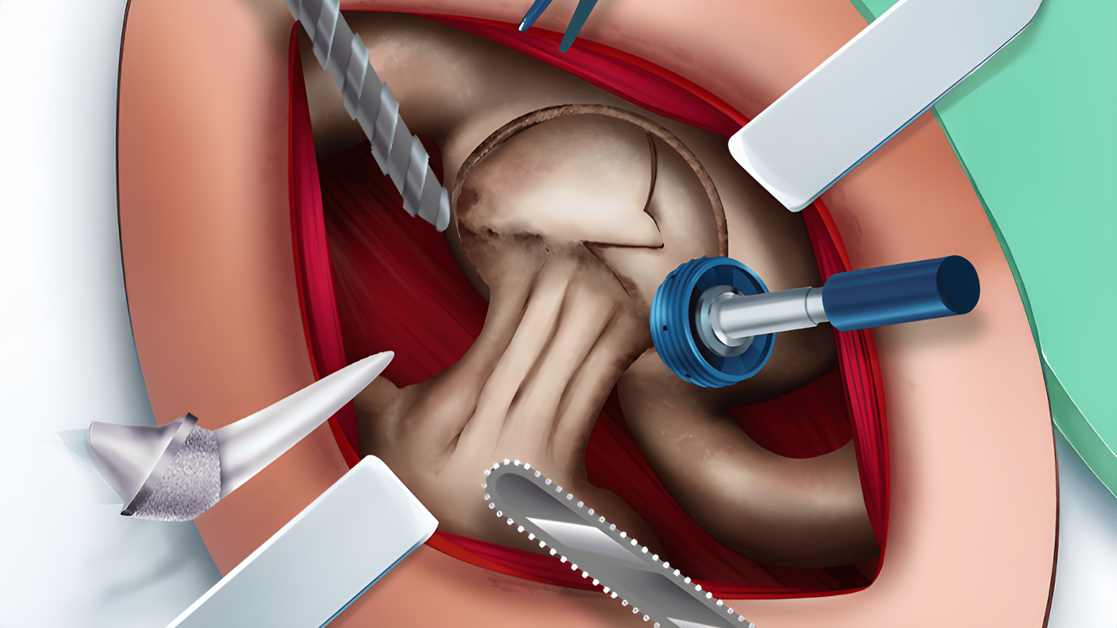 Ella Hip Surgery Logo