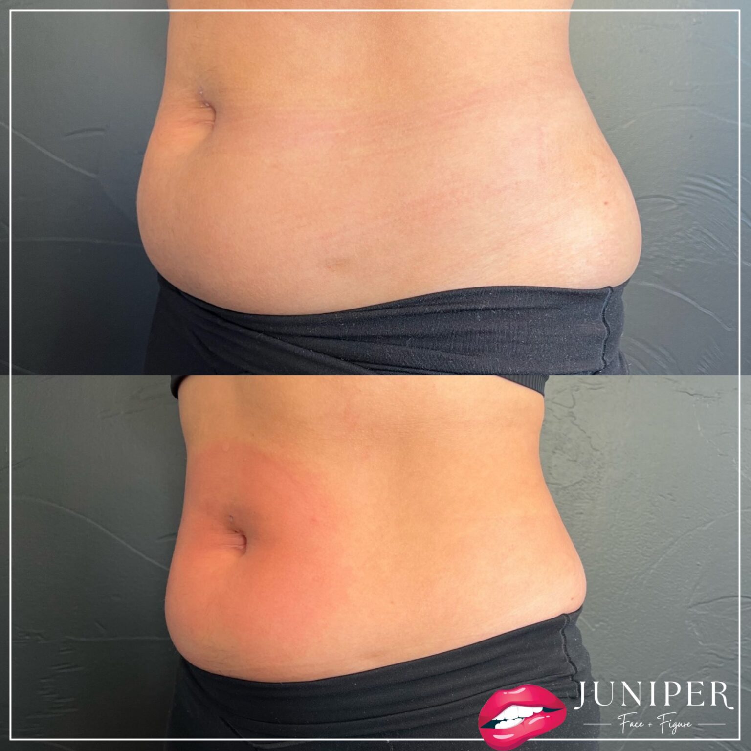 Winter Warriors: Stay Sculpted and Strong: EMSCULPT
