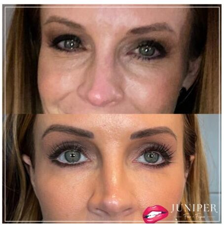 Bozeman Under-Eye Fillers: Restore a Youthful Look