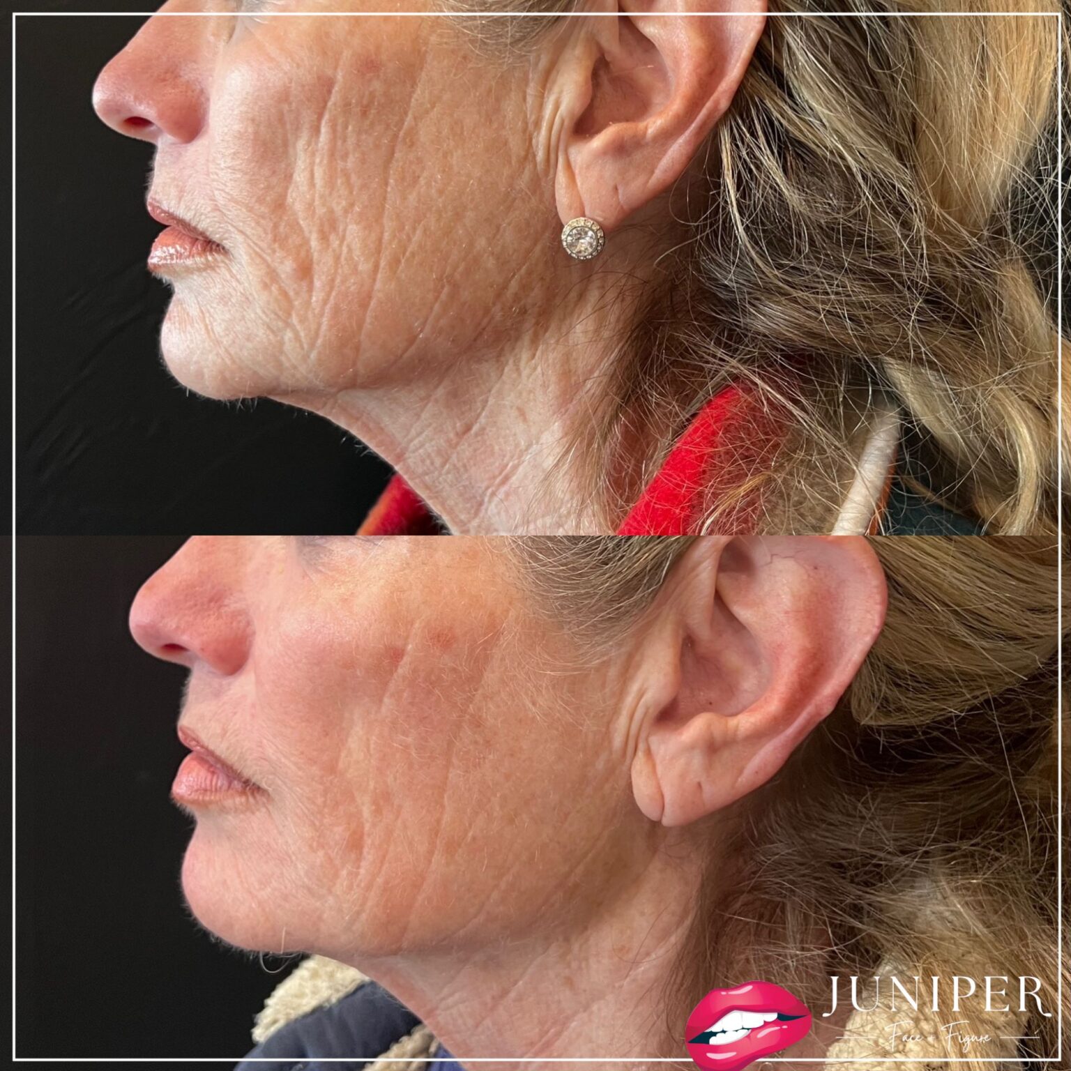 Skin Rejuvenation Showdown: Morpheus8 vs. EXION RF Microneedling