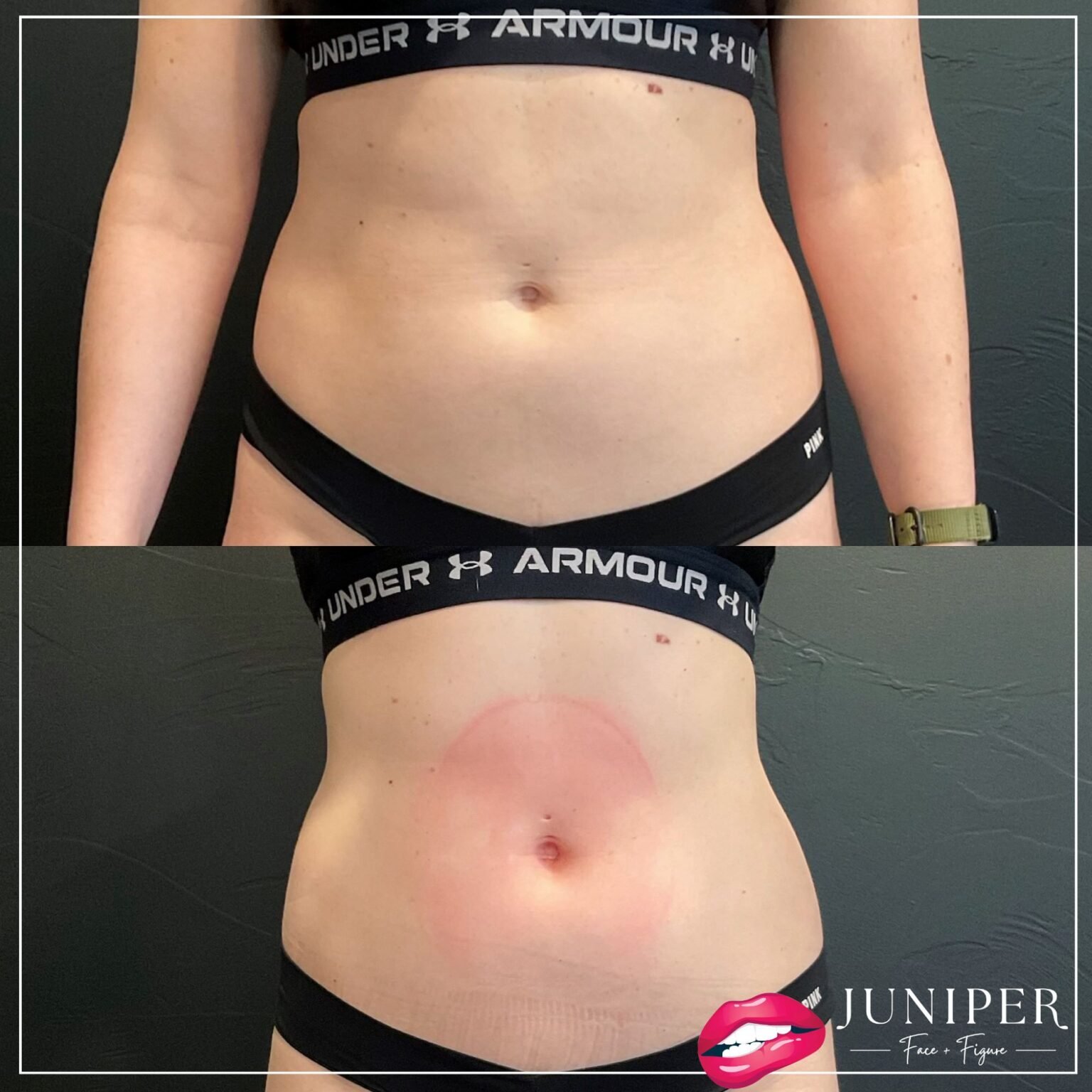 Yellowstone Confidence: Reveal Your Sculpted Physique with Juniper Face & Figure's EMSCULPT