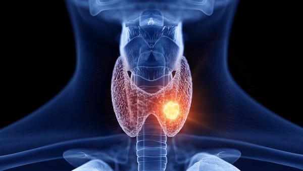 Computer simulation of Hashimoto's Disease