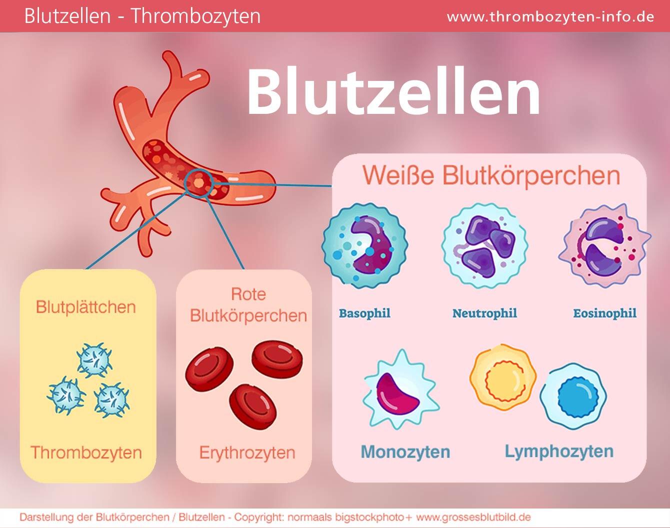 Thrombophlebitis