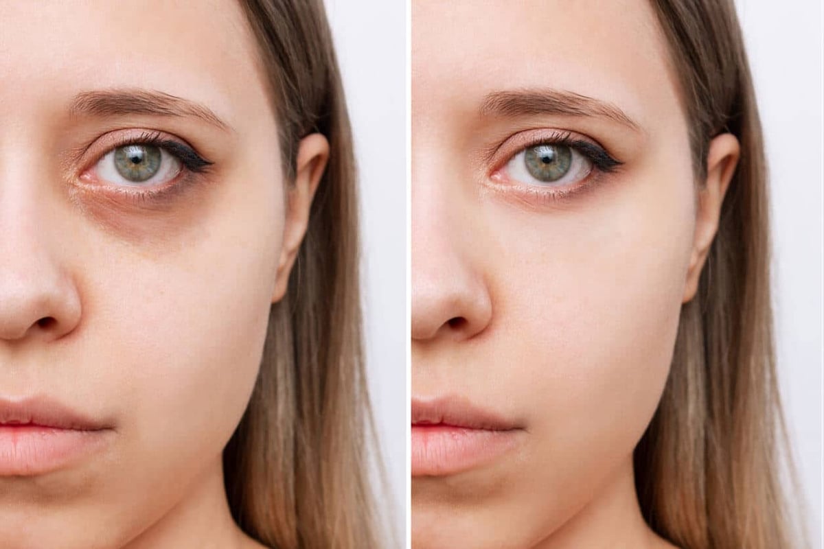 How to Get Rid of Dark Circles Under Eyes. Cropped shot of young caucasian woman's face with dark circles under eyes before and after cosmetic treatment. Bruises under eyes caused by fatigue, insomnia.