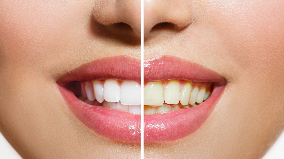5 Ways to Whiten Teeth Naturally