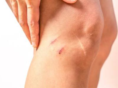 8 Ways to Get Rid of Dark Scars Effectively
